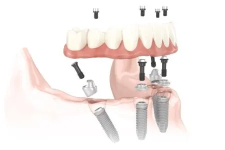 dental implant diagram 