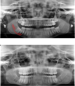 before and after x-ray of wisdom teeth removal