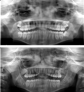 wisdom teeth removal x-rays
