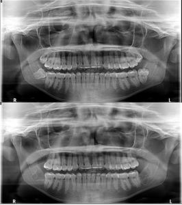 x-rays of wisdom teeth