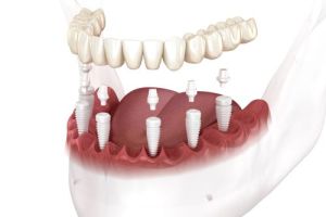 ceramic implant