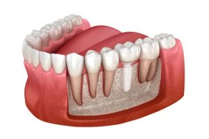 single ceramic implant