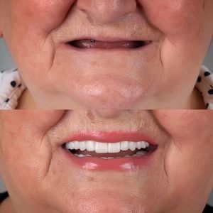 Implant Denture before and after patient
